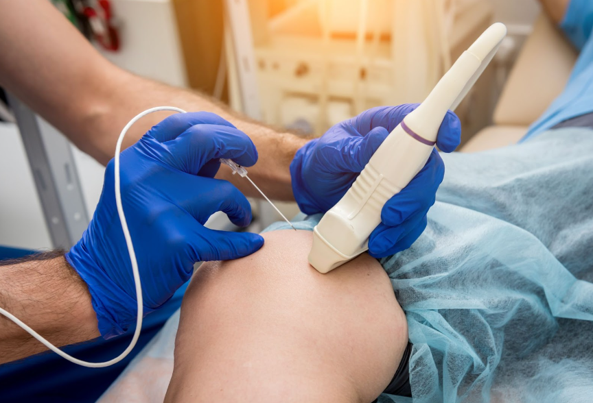 radiofrequency ablation for varicose veins