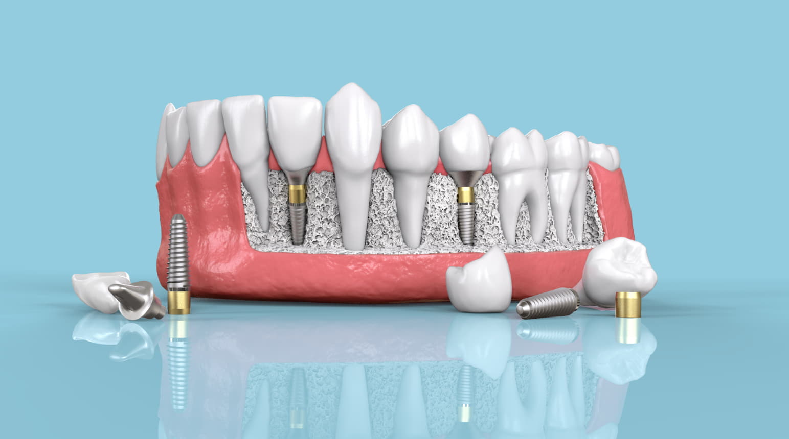 dental implants in a day