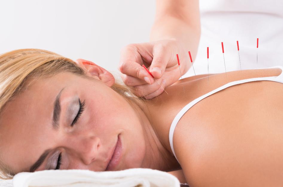 Acupuncture therapy in Kingscliff