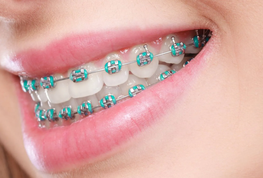 braces in Victoria