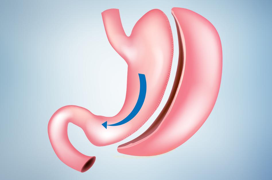 sleeve gastrectomy on the Gold Coast