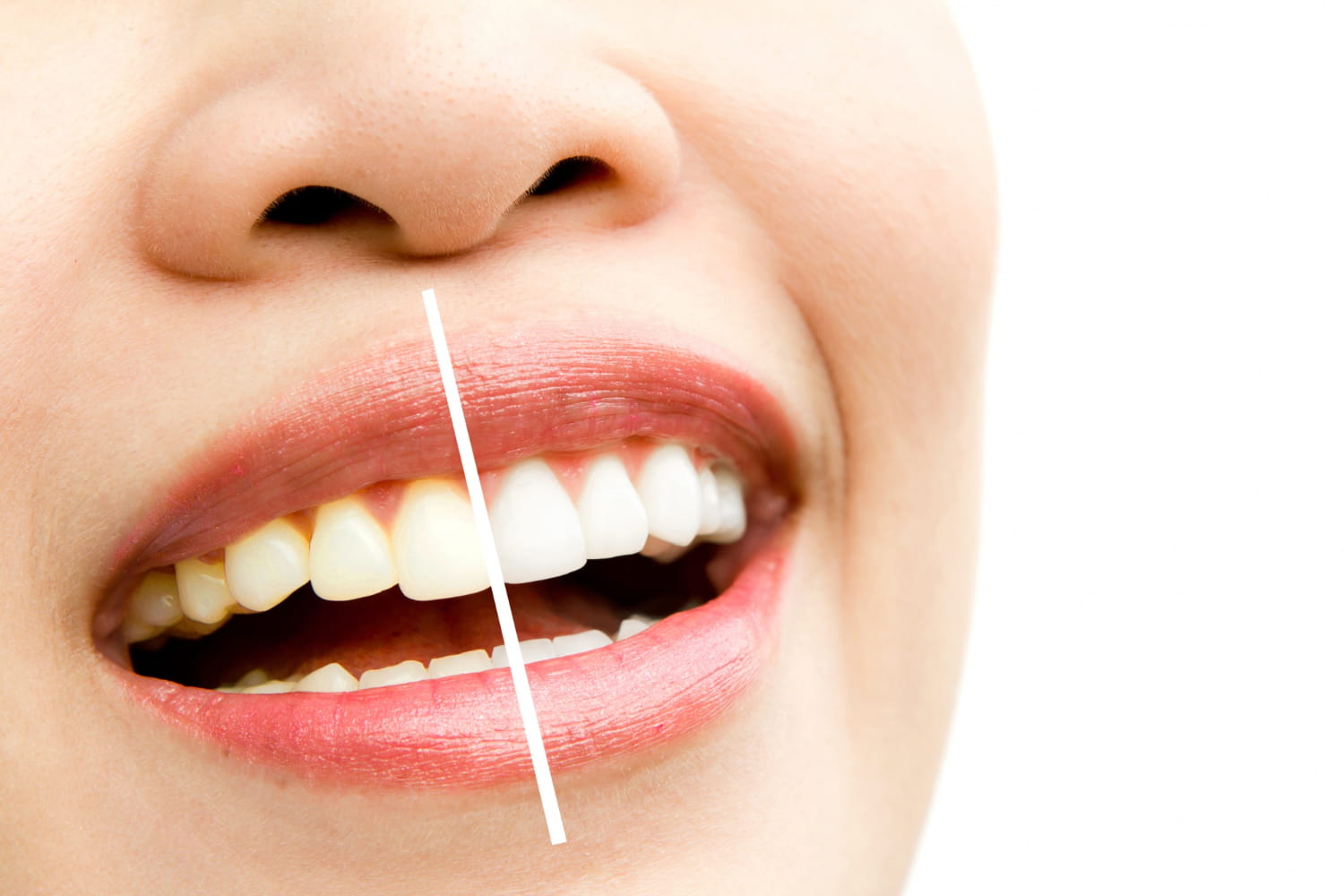teeth whitening services